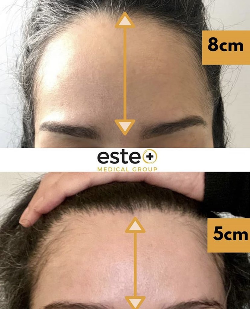 Forehead reduction FUE hair transplant Este Medical